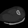 SPORK, NICO - 22.03.1976 - 02.08.2022 - CT obere Extremität - 18:02:23
